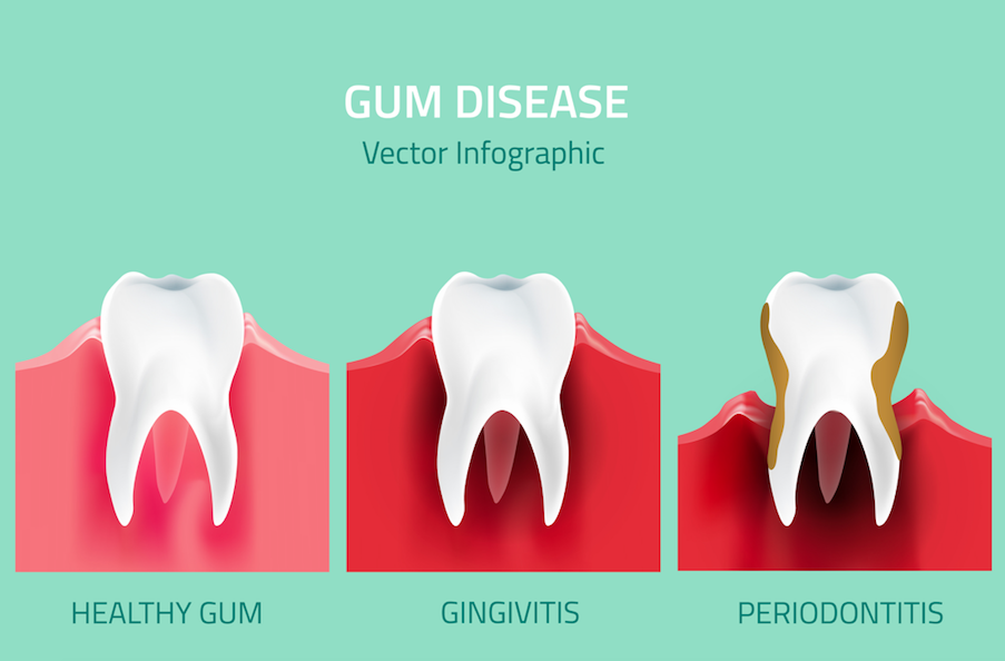 gum disease tell teeth stages