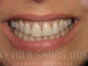 taylor swift teeth before veneers
