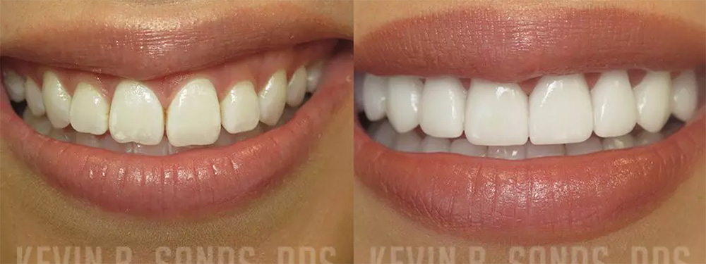 Before and after the placement of veneers in Beverly Hills, by Dr. Sands.