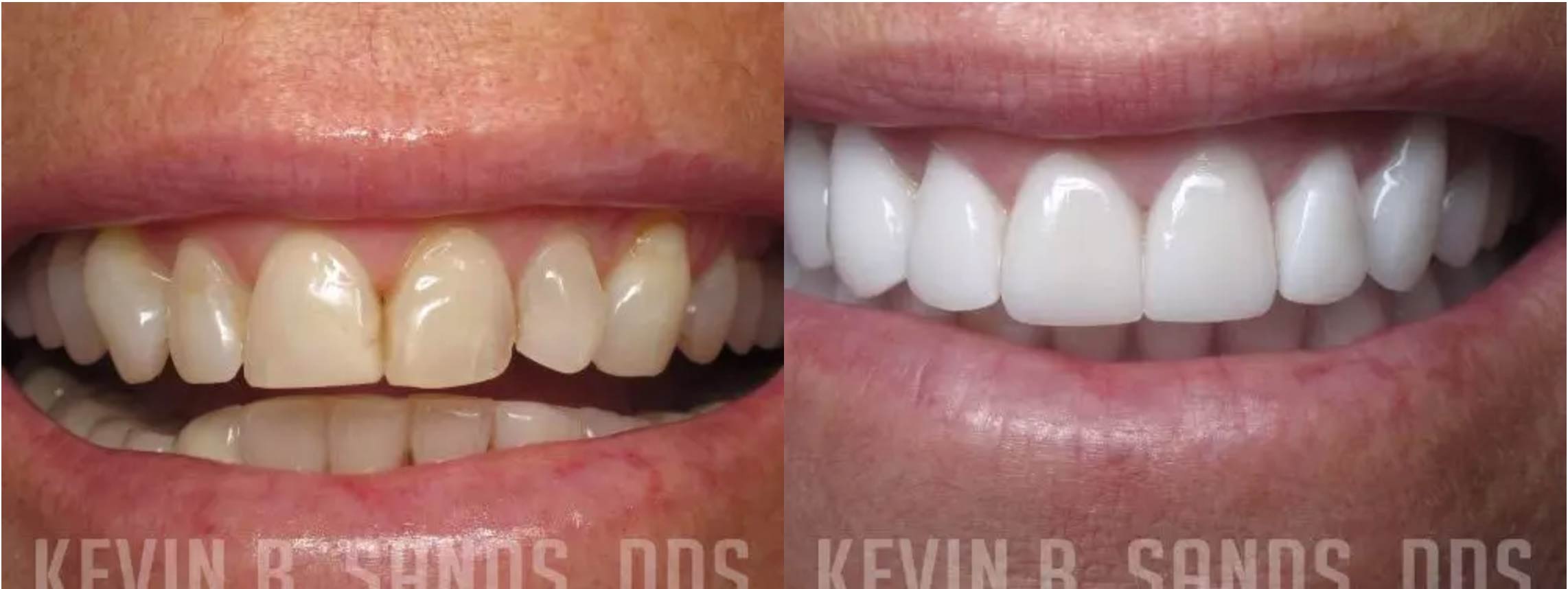 Porcelain veneer treatment - before and after.