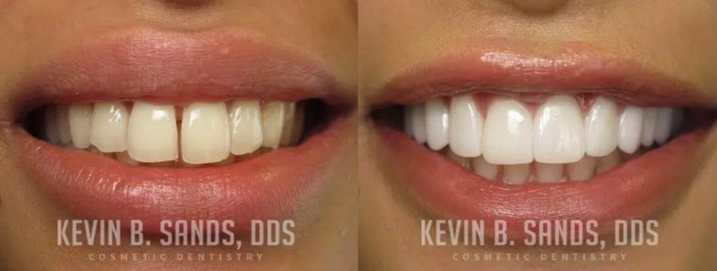 A porcelain veneers before and after pic.