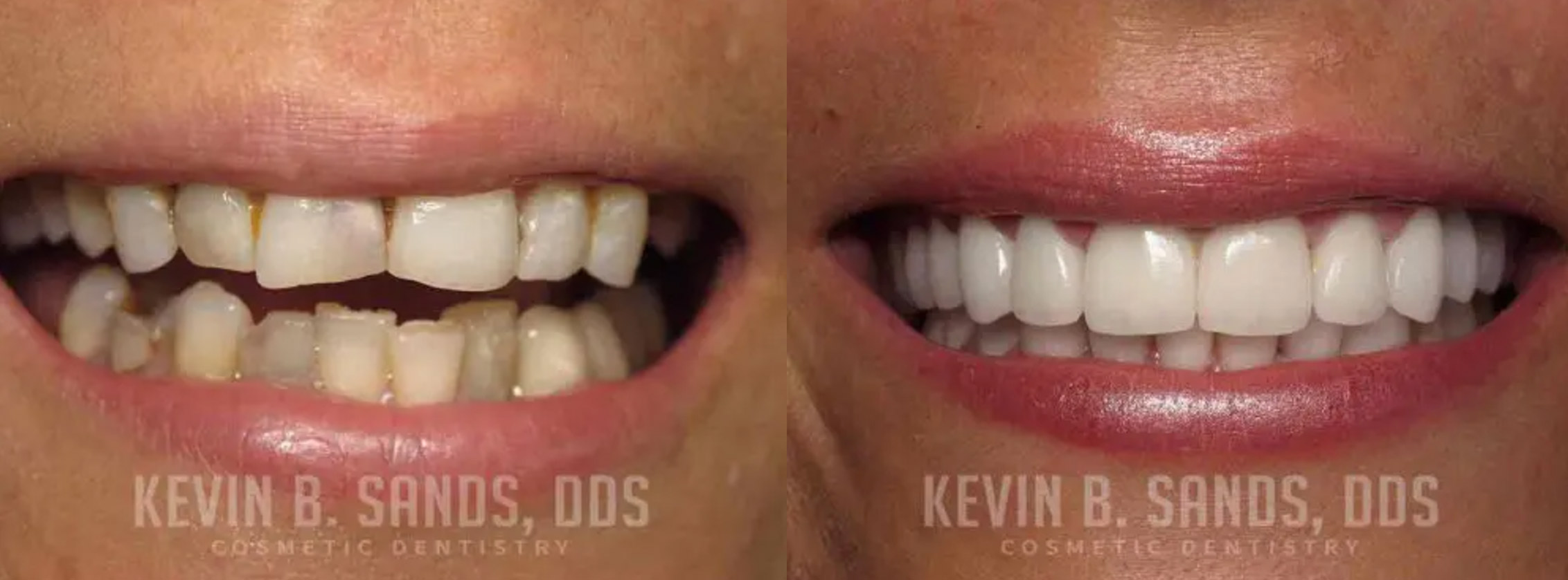 Orthodontic treatment before and after pic.