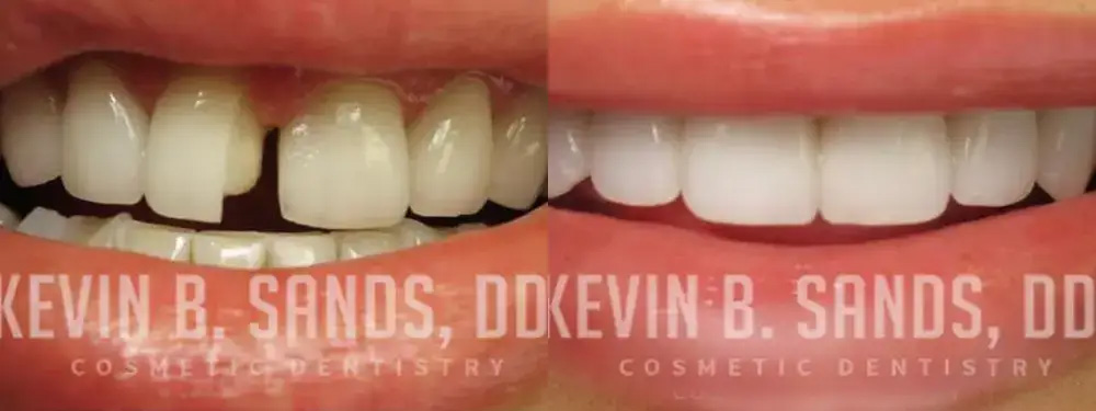 Dr. Sands Beverly Hills porcelain veneer before and after photo.