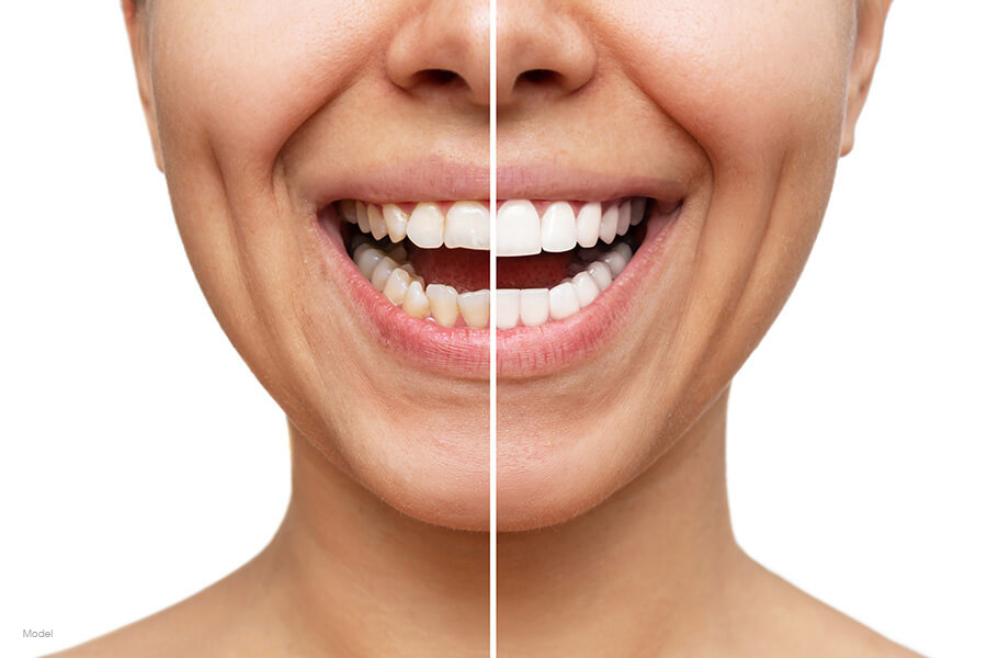 a split image of a woman's teeth before and after porcelain veneers.